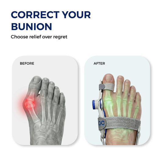 Bunion Corrector With Adjustable Knob - Fix Your Toe Alignment in Just 3 Weeks